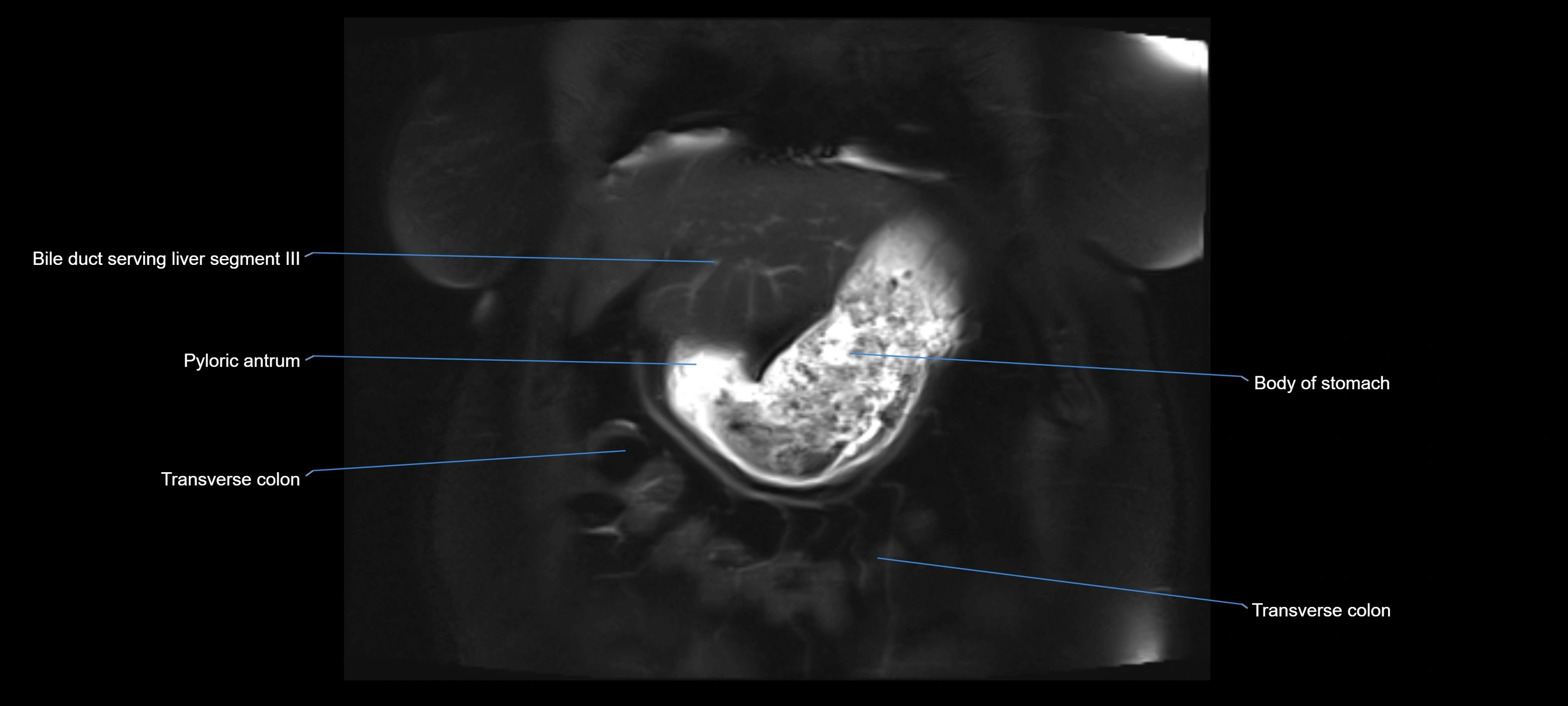 MRI MRCP coronal cross sectional 3T radiology  image-img-00001-00001.webp